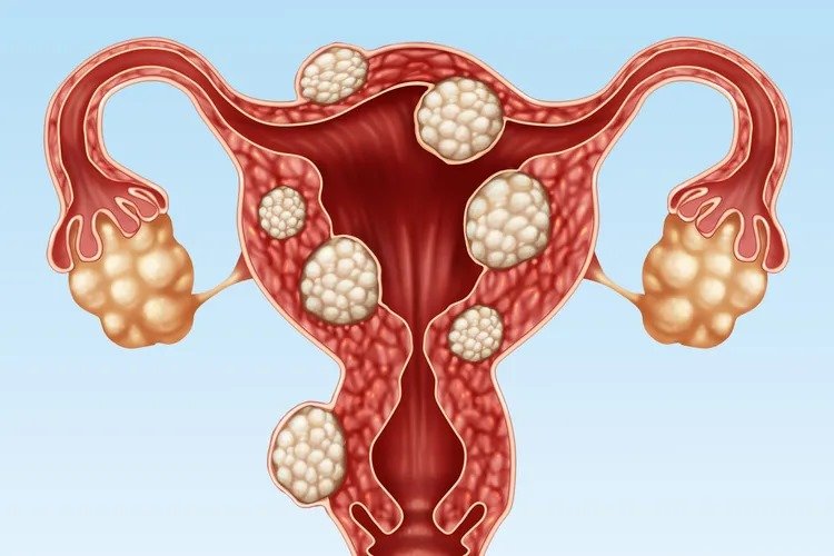 The Essential Guide To Uterine Fibroids Signs And Symptoms