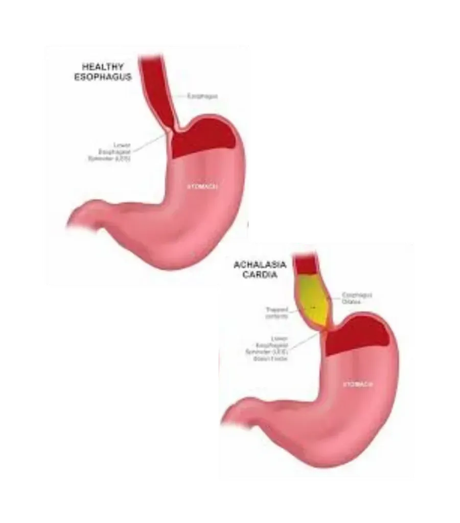Laparoscopic achalasia cardia surgery at Lux Hospitals, HITEC CITY, Hyderabad.
