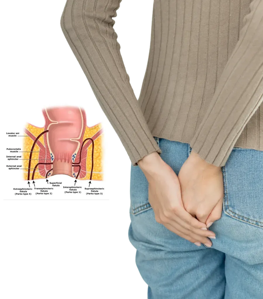 Laser anal fistula surgery at Lux Hospitals, HITEC CITY, Hyderabad.