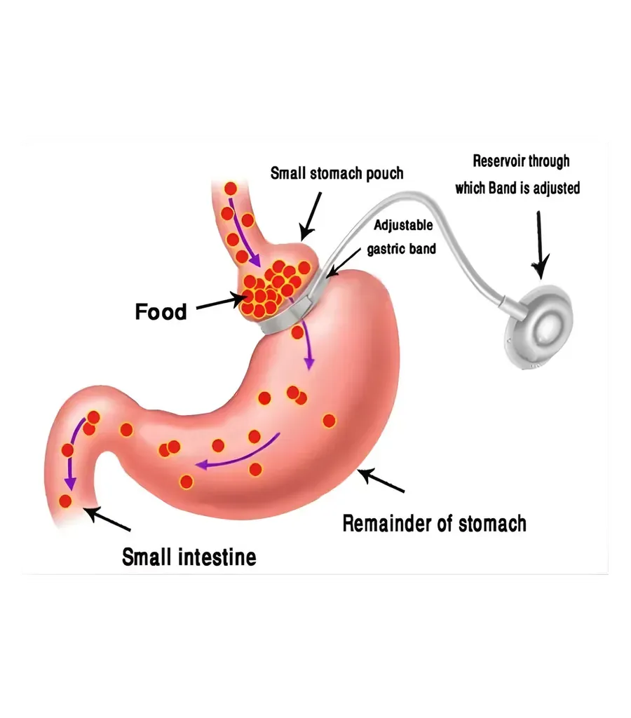 Laparoscopic adjustable gastric band surgery at Lux Hospitals, HITEC CITY, Hyderabad.