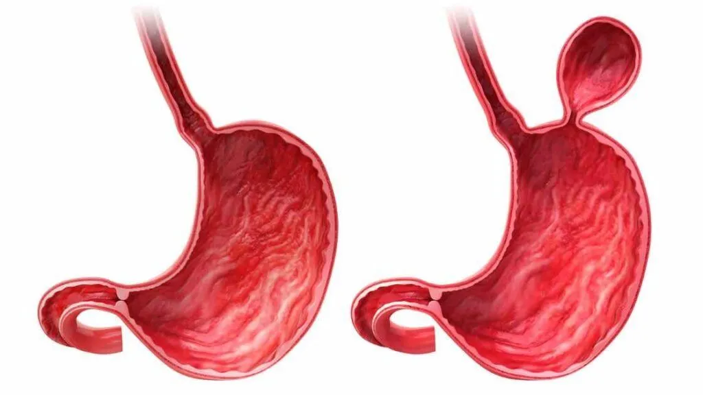 hiatal hernia