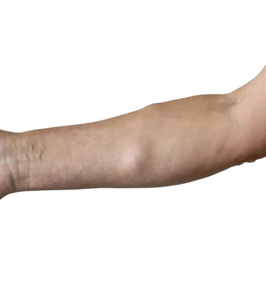 Lipoma removal at Lux Hospitals, HITEC CITY, Hyderabad.