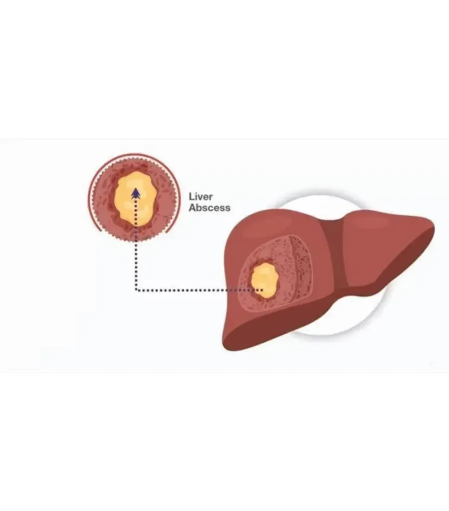 Liver abscess drainage at Lux Hospitals, HITEC CITY, Hyderabad.