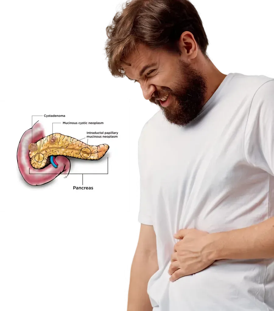 Pancreatic tumour surgery at Lux Hospitals, HITEC CITY, Hyderabad.