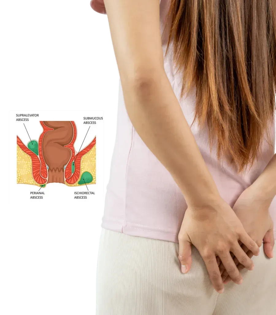 Perianal abscess drainage at Lux Hospitals, HITEC CITY, Hyderabad.