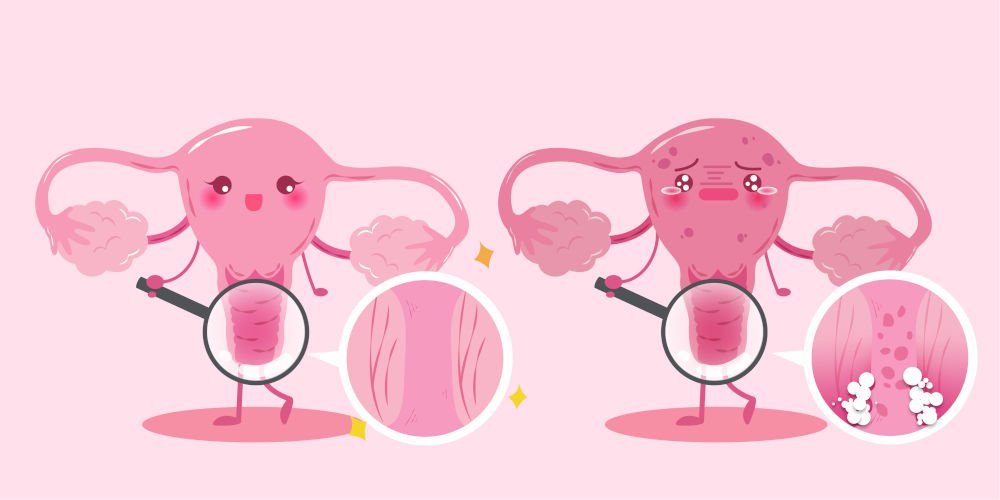 vaginal yeast infection
