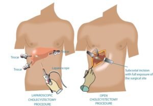 gallbladder removal