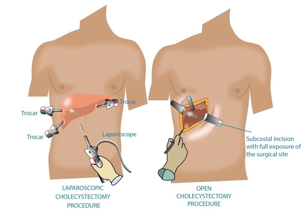 Gallbladder Removal: Ultimate Guide to Laparoscopic Success