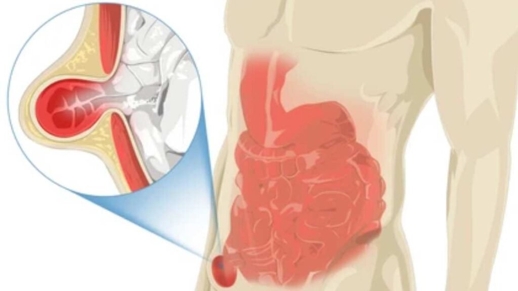 How to Prevent a Hernia: Essential Strategies for a Stronger Core