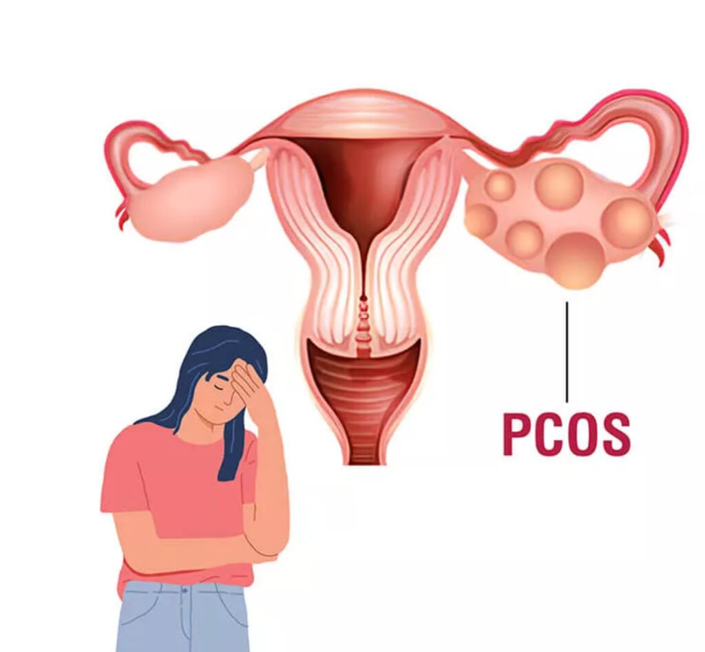 Your Ultimate Guide to Polycystic Ovary Syndrome (PCOS)