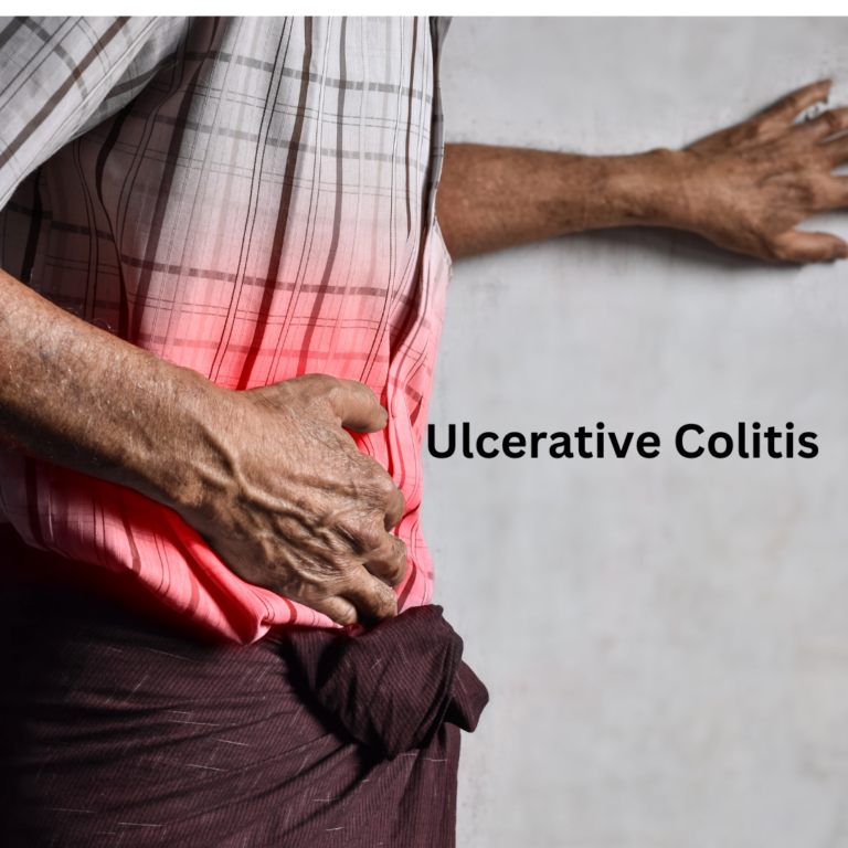 signs of ulcerative collitis