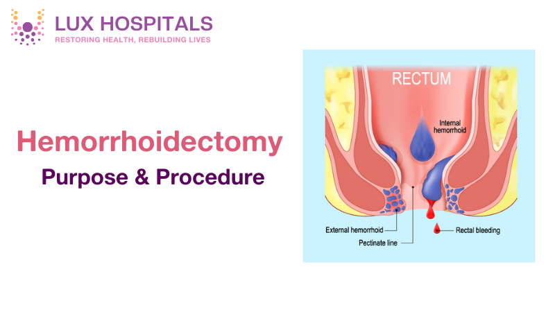 Hemorrhoidectomy: A Guide to Purpose and Procedure