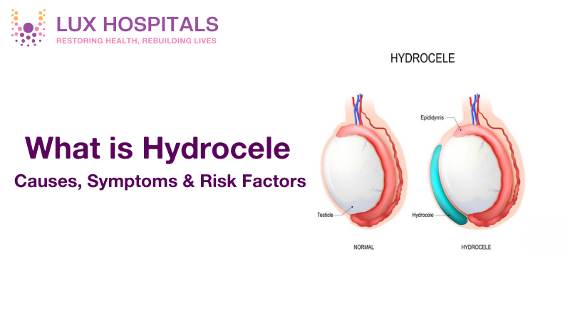 What is hydrocelectomy? Understanding the Procedure and Its Benefits