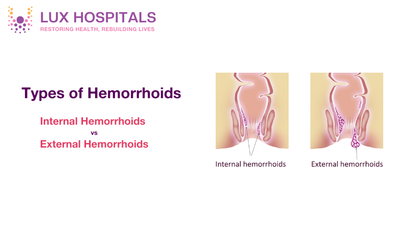 Types of Hemorrhoids