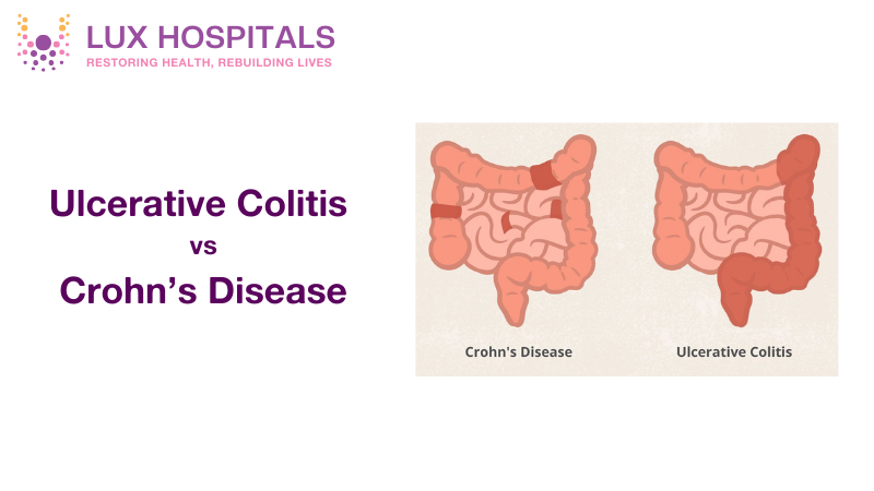 Ulcerative Colitis vs. Crohn's Disease