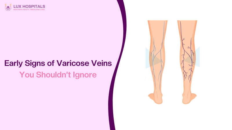 Signs of Varicose Veins