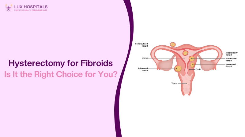 Hysterectomy for Fibroids