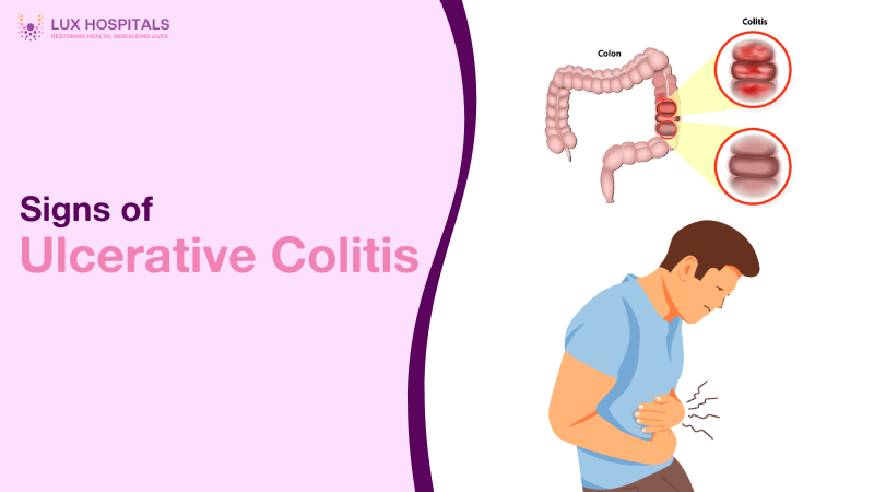 Early Signs of Ulcerative Colitis You Shouldn’t Ignore