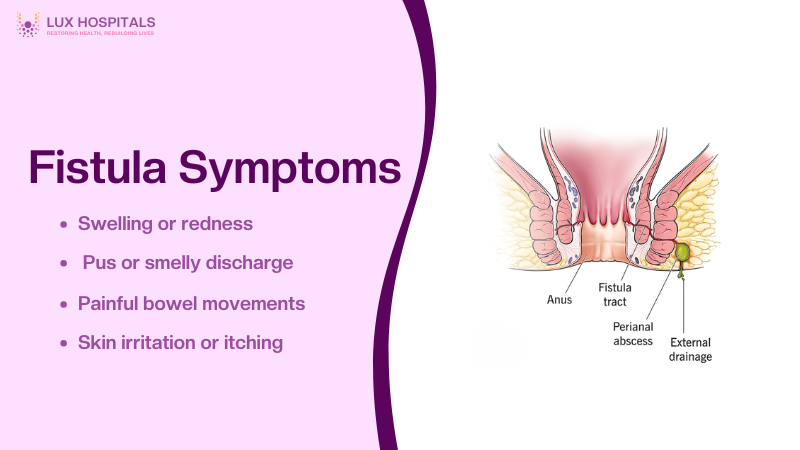Fistula Symptoms and Risks: When to Seek Immediate Medical Attention