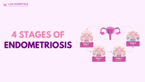 Stages of Endometriosis