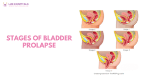 Stages of Bladder Prolapse