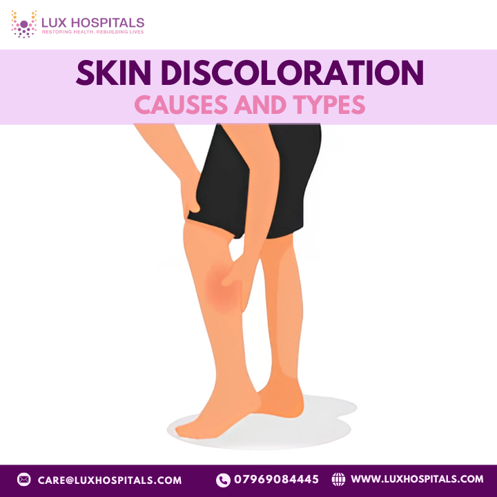 Skin Discolouration: Causes, Types & When to See a Doctor?