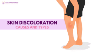 Skin discoloration