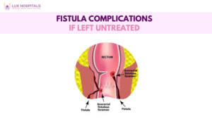 Fistula Complications if left untreated