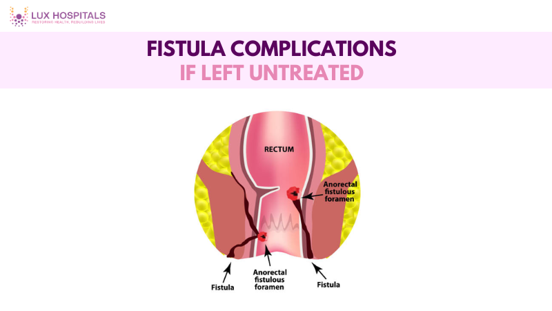 Fistula Complications if left untreated