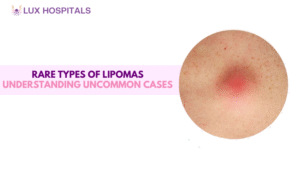 Rare Types of Lipomas: Understanding Uncommon Cases