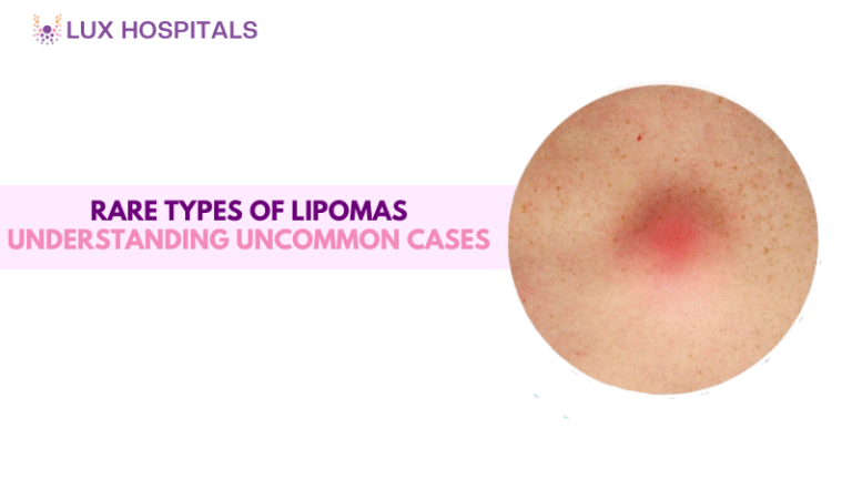 Rare Types of Lipomas: Understanding Uncommon Cases