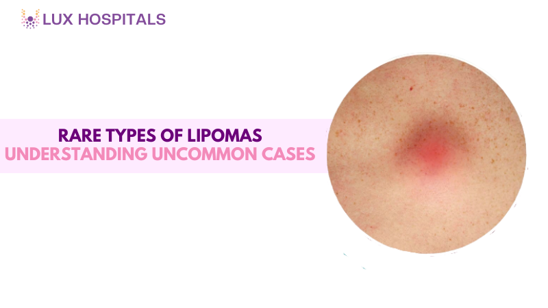 Rare Types of Lipomas: Understanding Uncommon Lipoma Cases