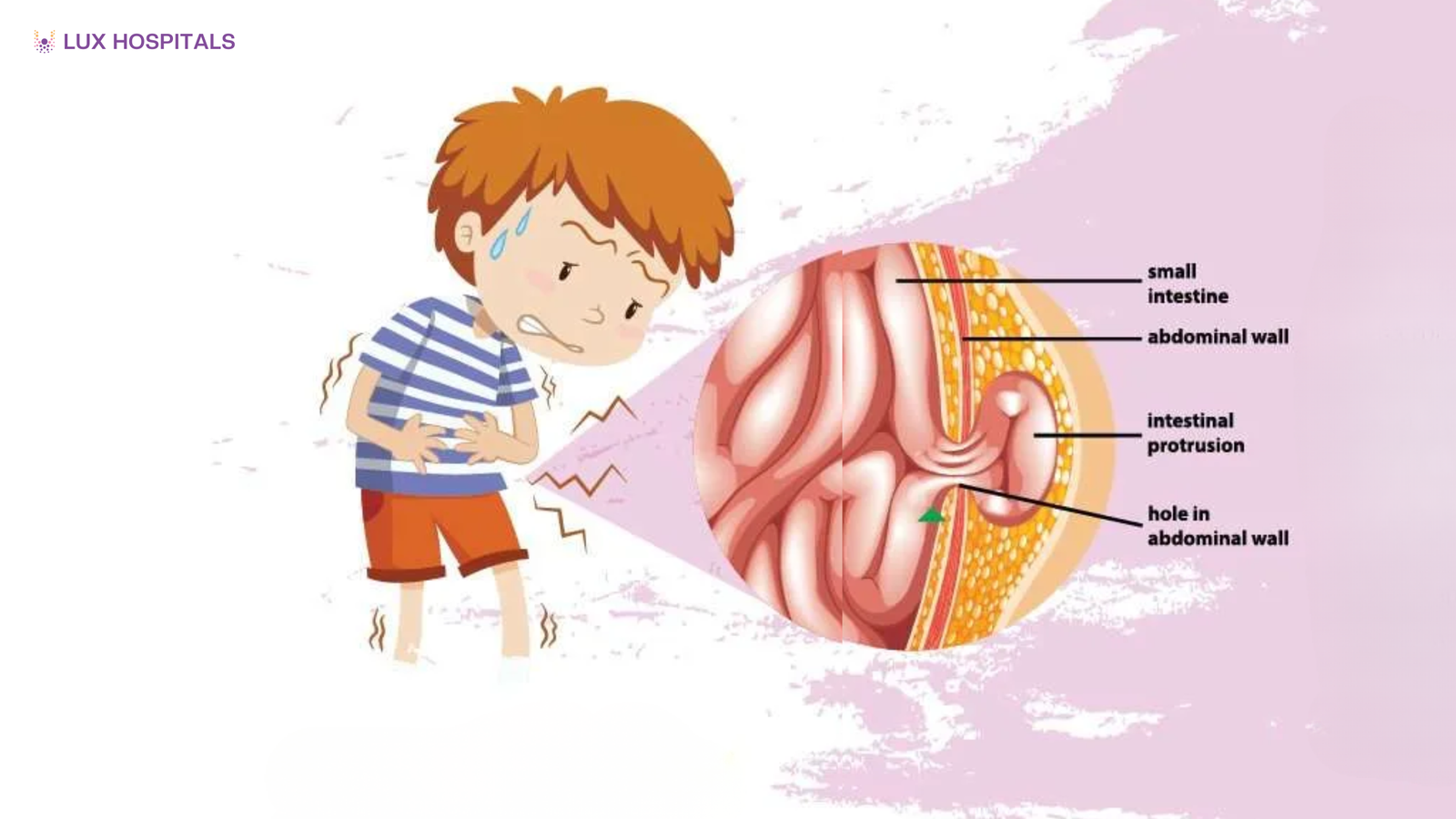 Hernia in Children: Symptoms, Diagnosis and Treatment