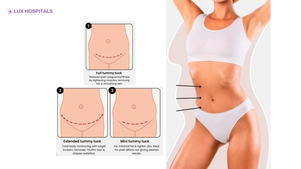 Types of Tummy Tuck Surgery: Full, Mini, and Extended