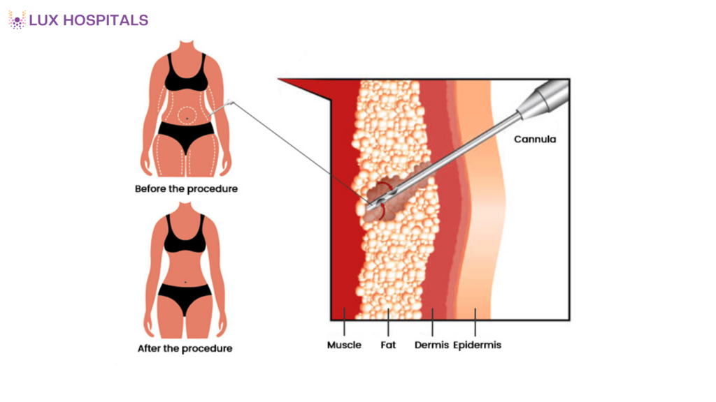 Cost of Liposuction in India: What Influences the Price?