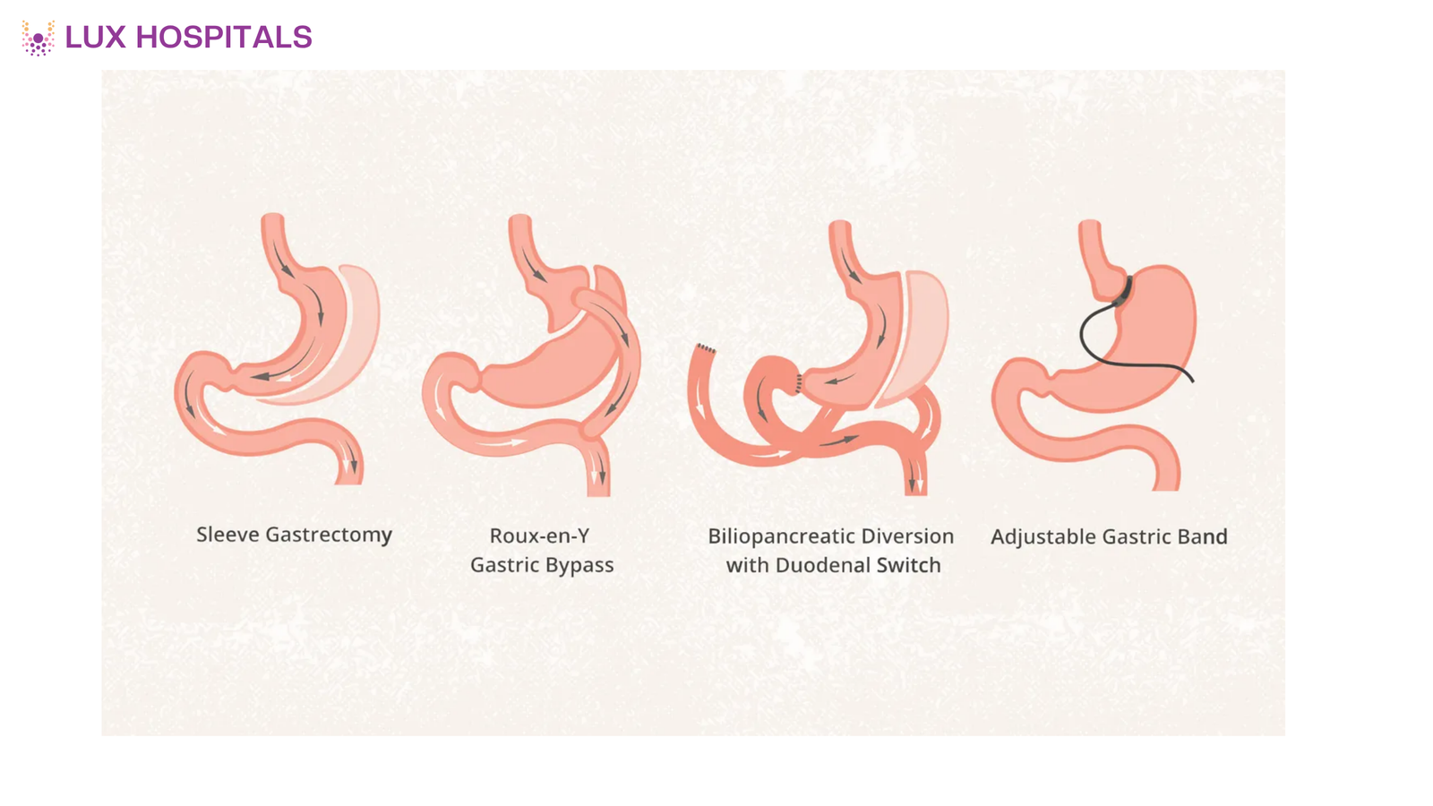 Bariatric Surgery – Benefits & Who Needs It