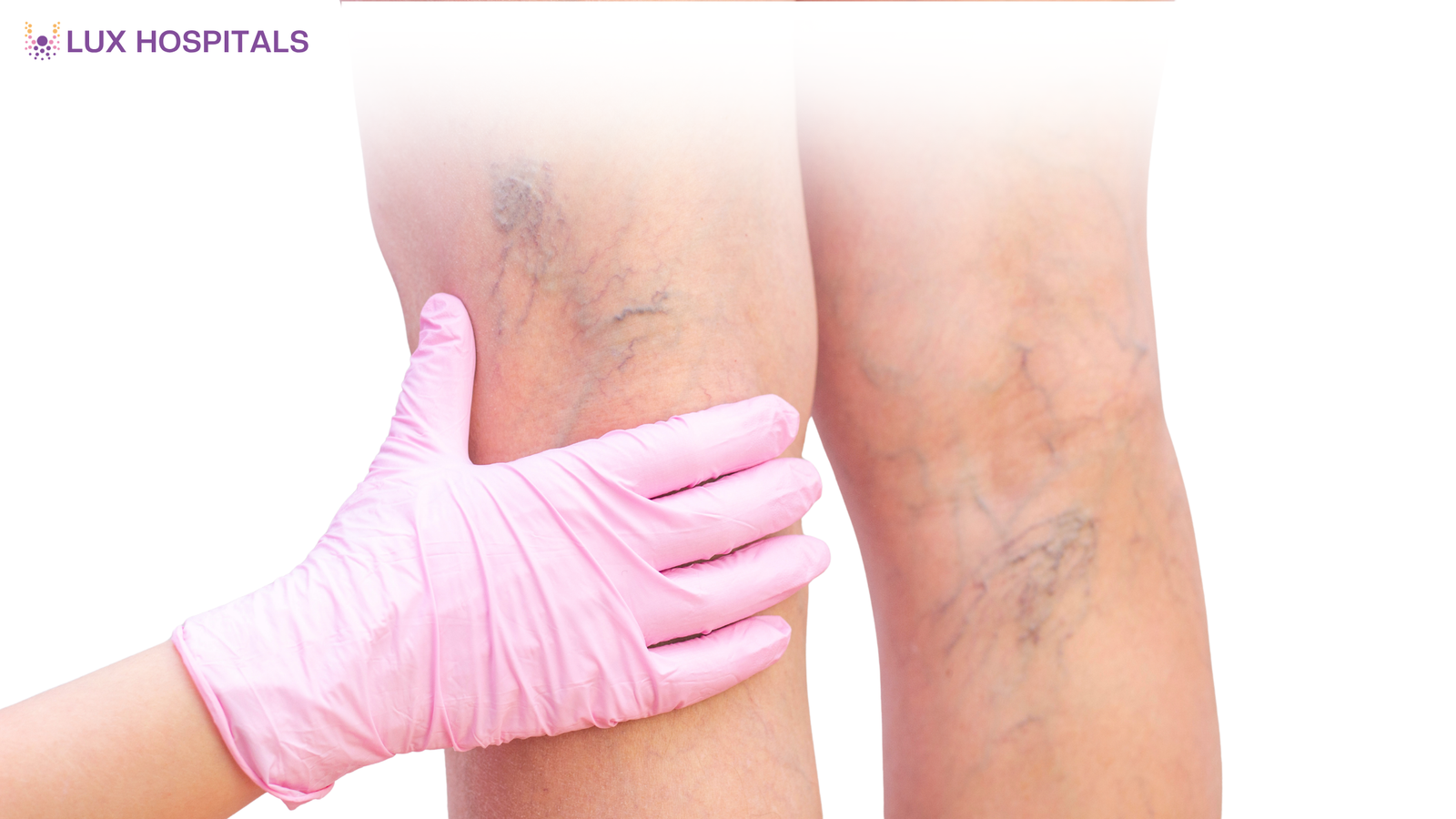 Hormones and Varicose Veins: What Women Should Know