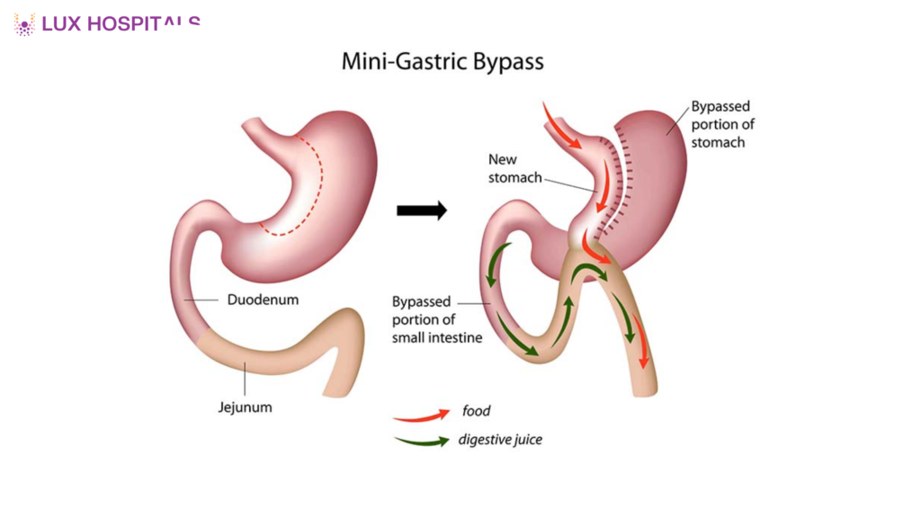 How Does Mini Gastric Bypass Work for Weight Loss?