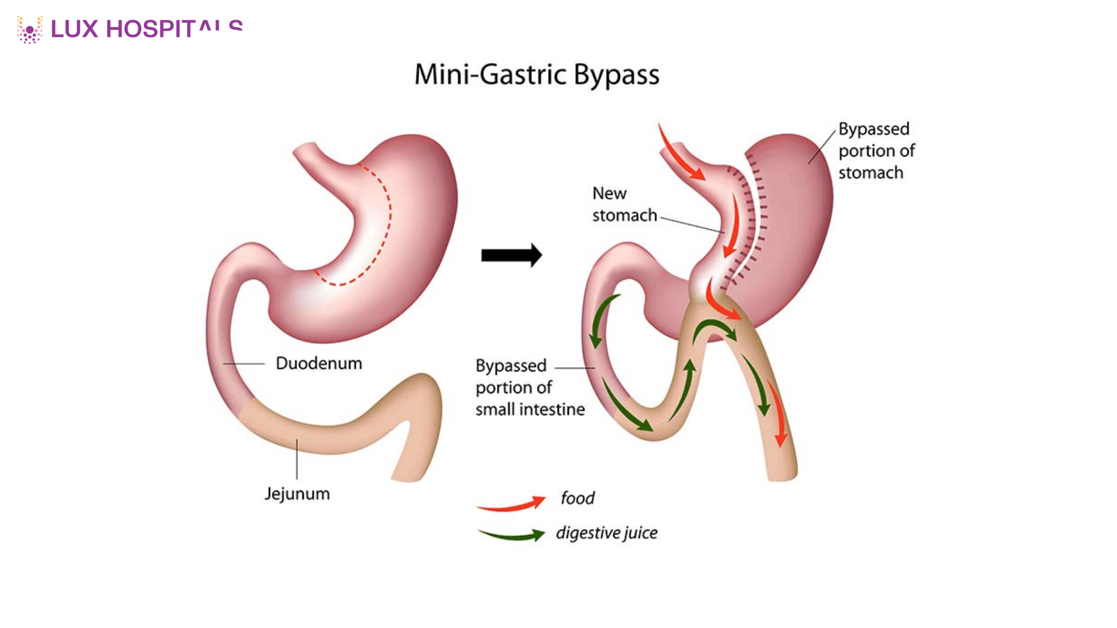 How Does Mini Gastric Bypass Work for Weight Loss?