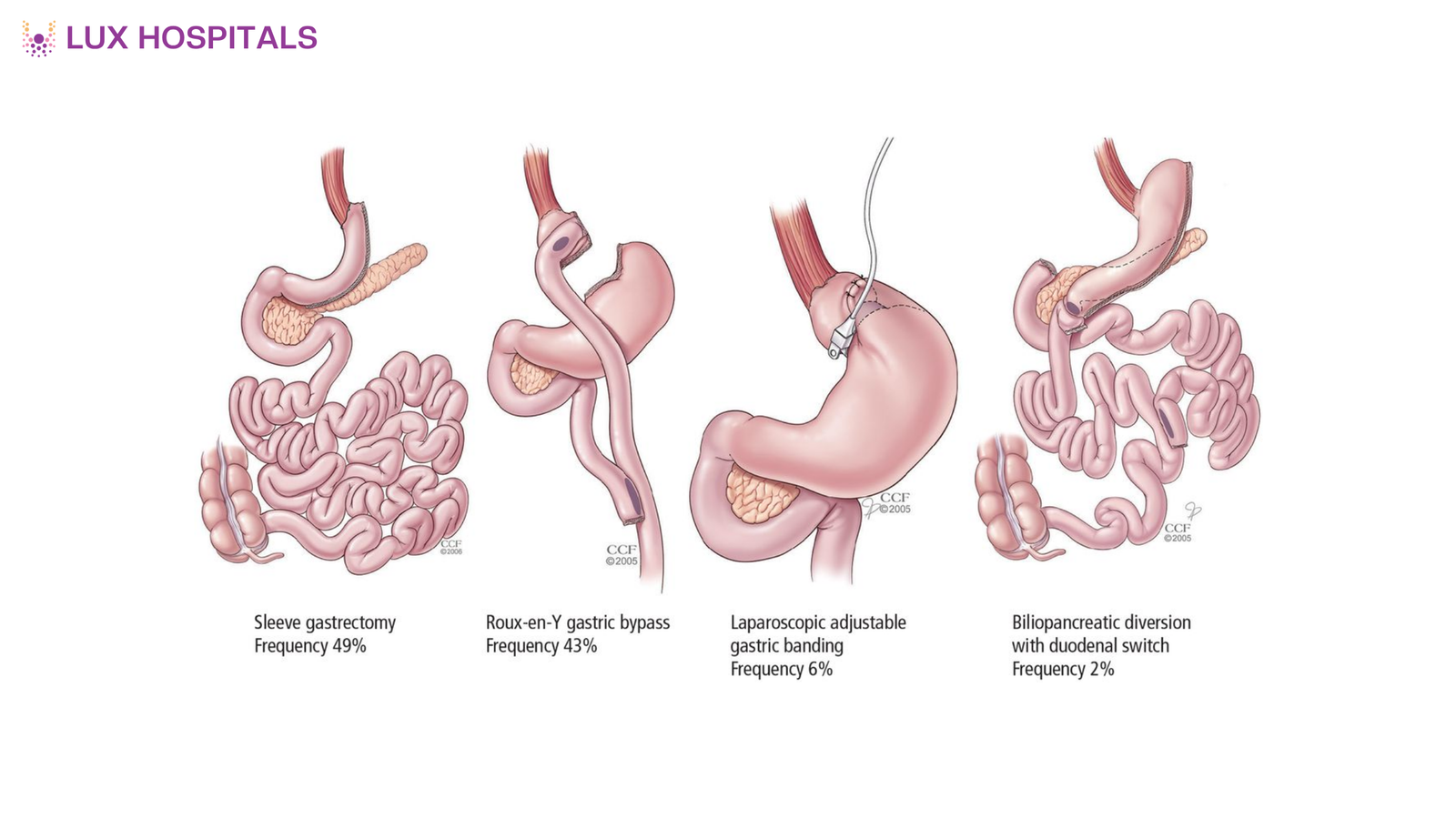 Metabolic Surgery for Type 2 Diabetes: How It Works
