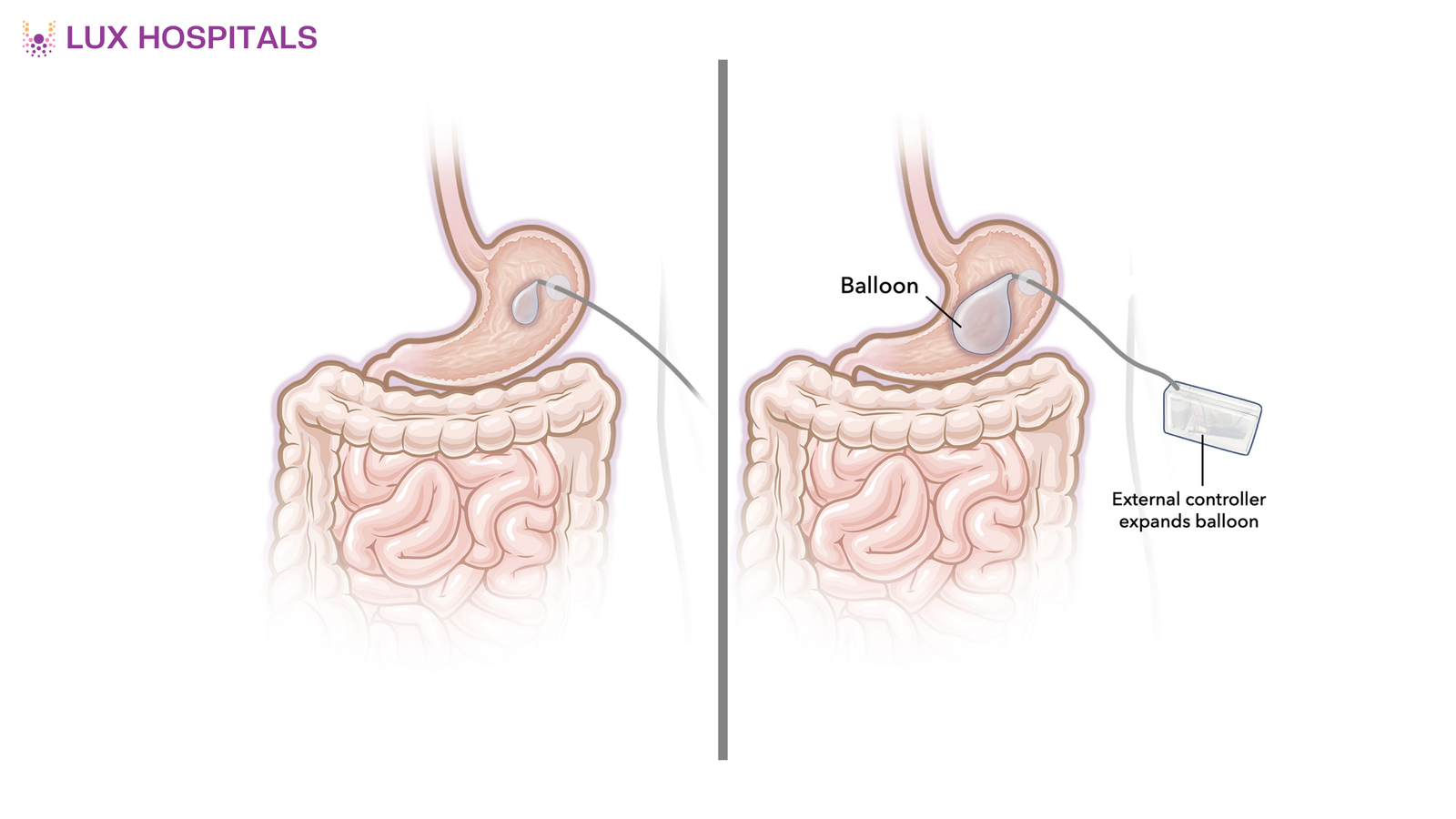 Why the Gastric Balloon is Becoming Popular for Weight Loss