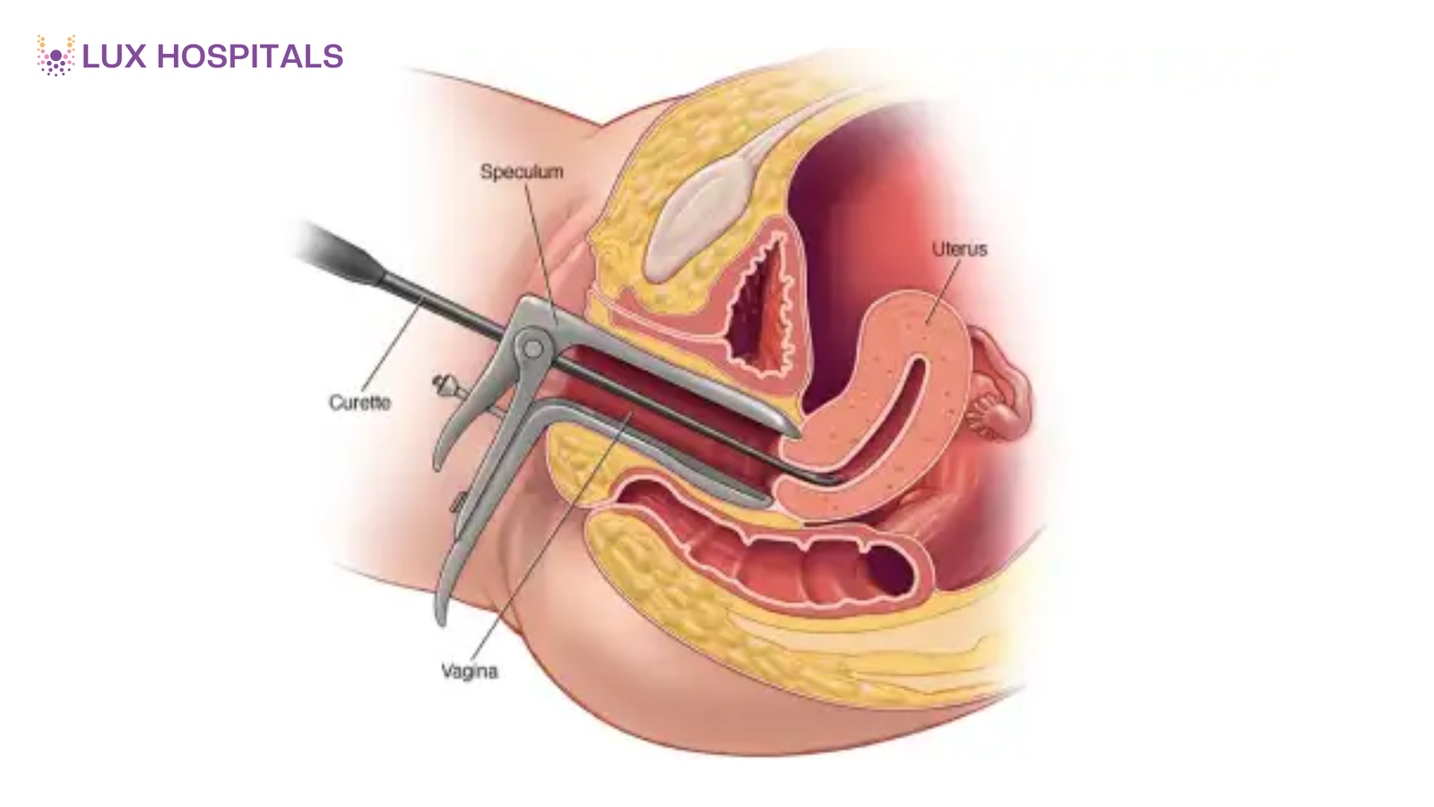 Dilation and Curettage (D&C): When Is It Required?