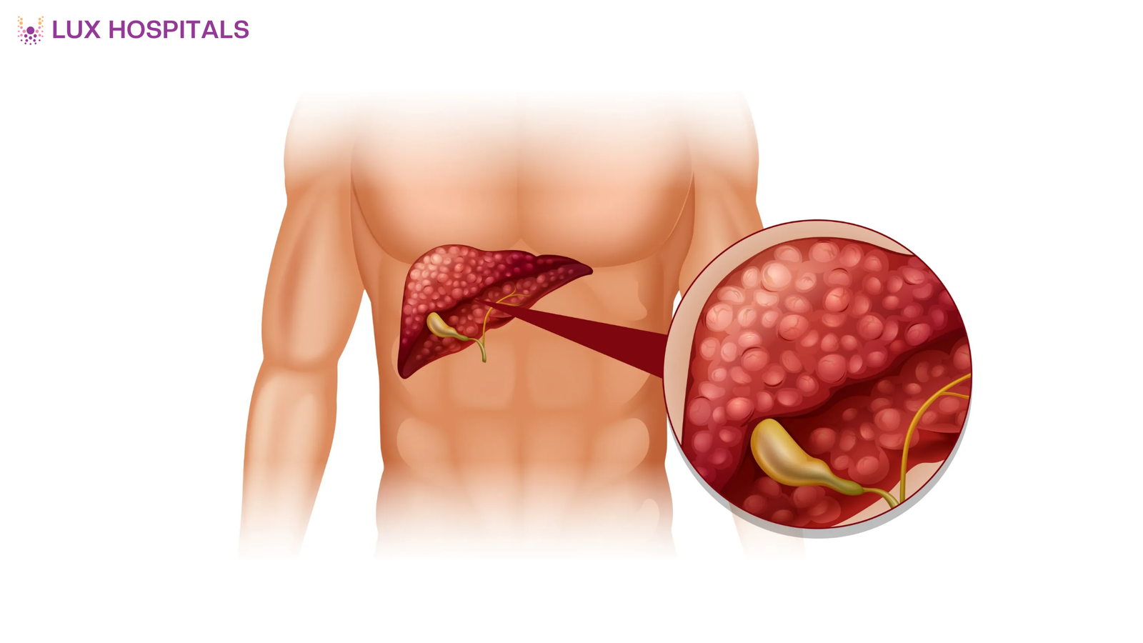 Early Warning Signs of a Liver Abscess