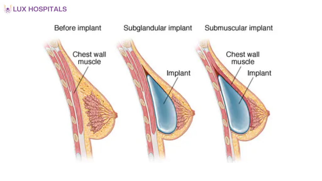 How Breast Augmentation Surgery Is Performed: A Complete Patient Guide