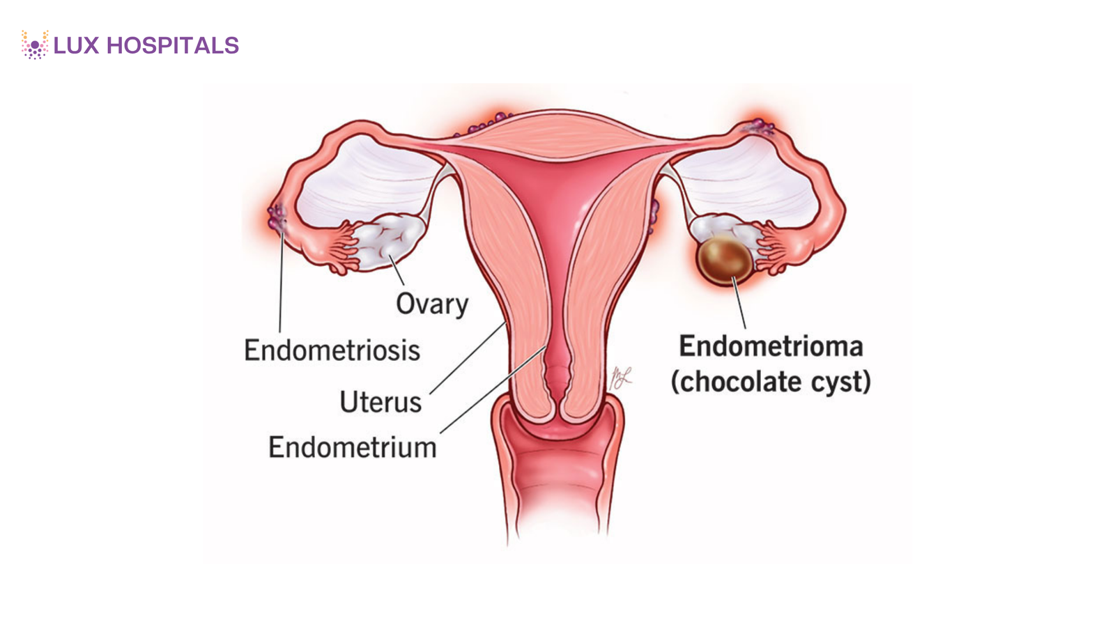 What Is an Endometrioma? A Cyst Linked to Endometriosis