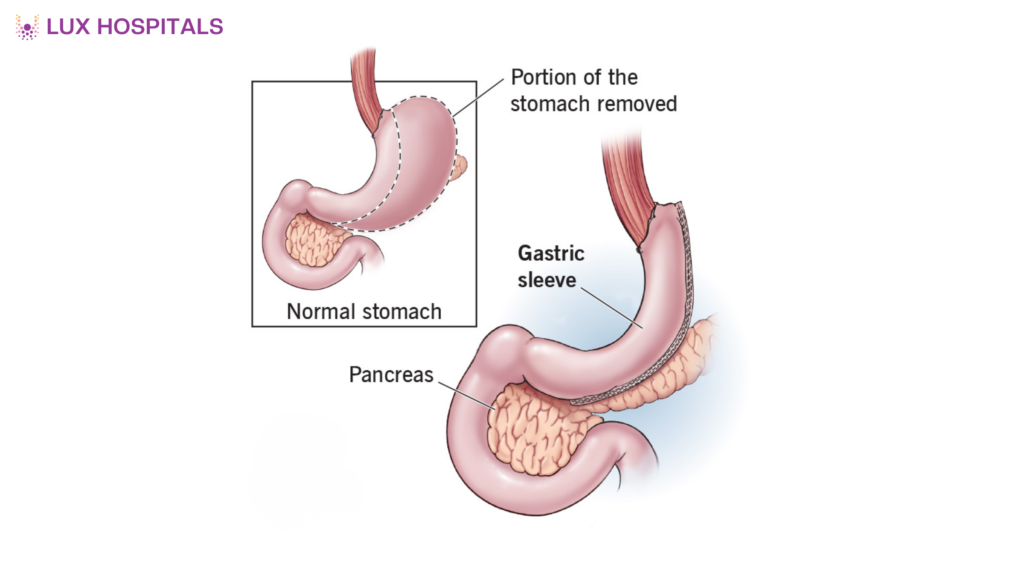 What is Sleeve Gastrectomy? Procedure, Benefits & Risks