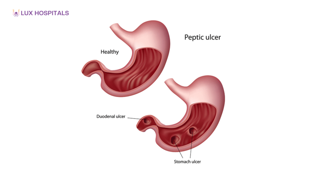 Bleeding Peptic Ulcer: Symptoms and Emergency Warning Signs
