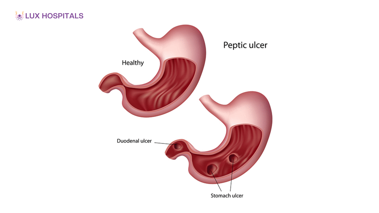 Bleeding Peptic Ulcer: Symptoms and Emergency Warning Signs