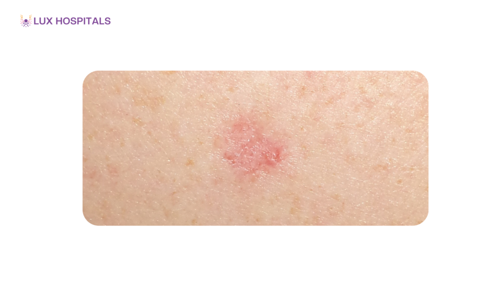 Early Signs of Skin Tumours You Should Not Ignore
