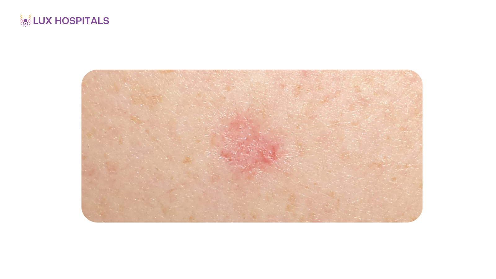 Early Signs of Skin Tumours You Should Not Ignore